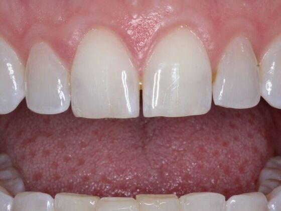 Gap Closure Case 1 - Before