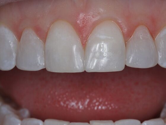 Gap Closure Case 1 - After