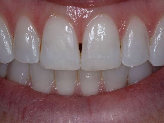 Gap Closure Case 2 - Before