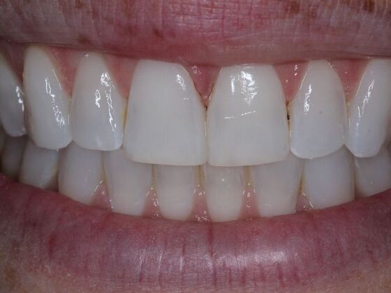 Gap Closure Cases