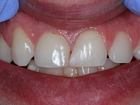 Gap Closure Case 3 - Before
