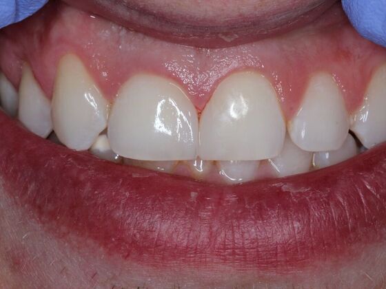 Gap Closure Case 3 - After