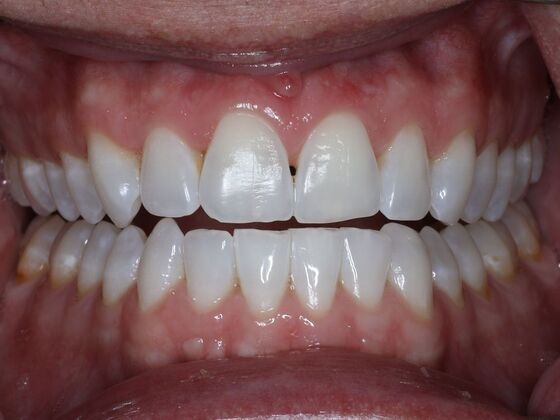 Gap Closure Case 4 - Before