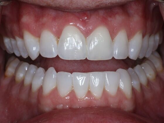 Gap Closure Case 4 - After