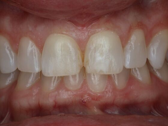 Gap Closure Case 5 - Before
