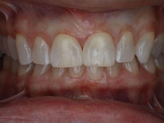 Gap Closure Case 5 - After