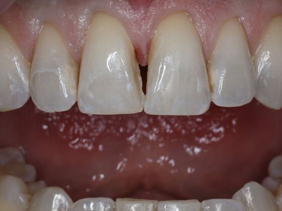 Gap Closure Case 6 - Before