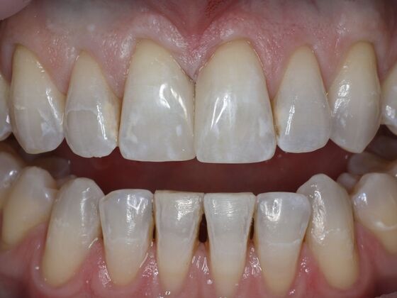Gap Closure Case 6 - After