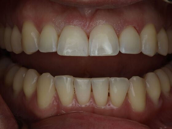 Gap Closure Case 7 - After