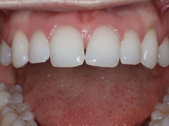 Gap Closure Case 8 - Before