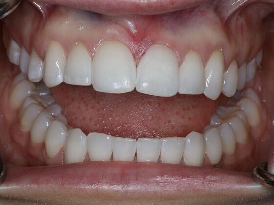 Gap Closure Case 8 - After