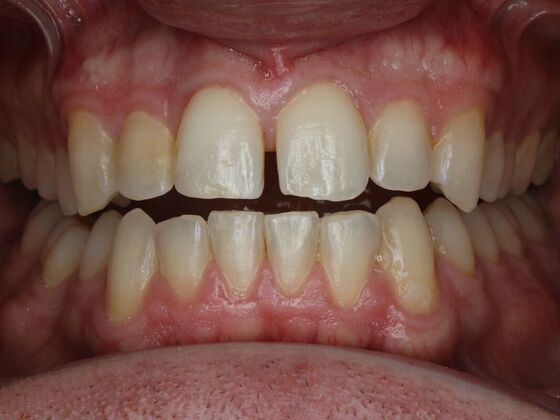 Gap Closure Case 9 - Before
