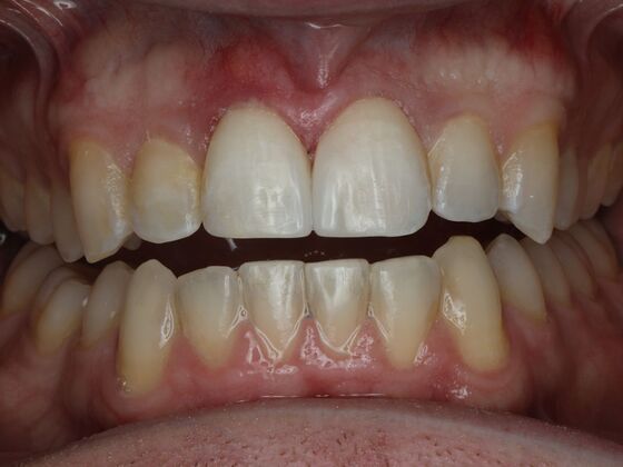 Gap Closure Case 9 - After