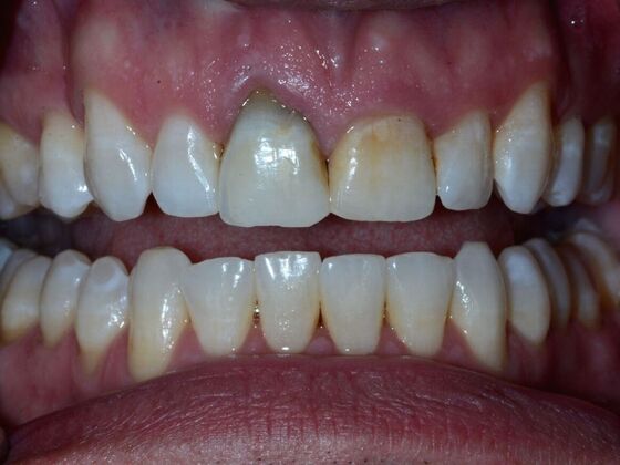 Dental Implants Case 5 - Before