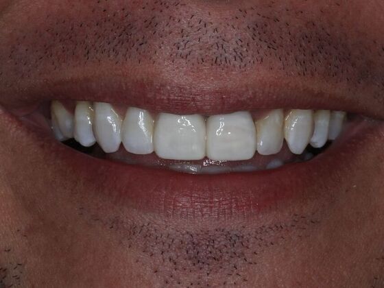 Dental Implants Cases