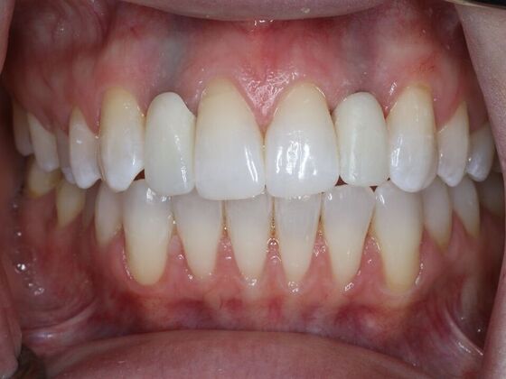 Dental Implants Case 6 - After
