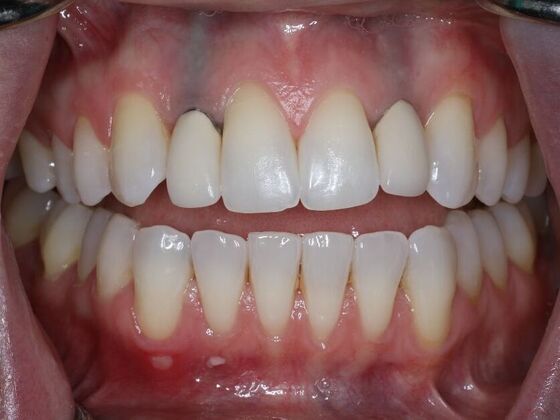 Dental Implants Case 6 - Before