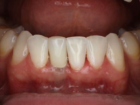Dental Implants Case 7 - After