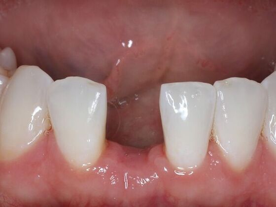 Dental Implants Case 7 - Before
