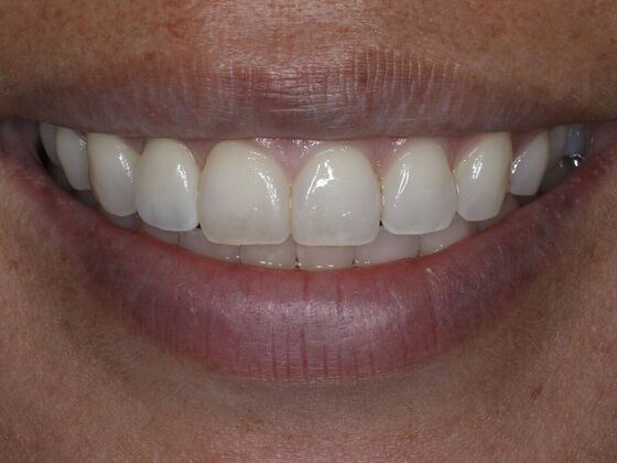 Dental Implants Case 8 - After