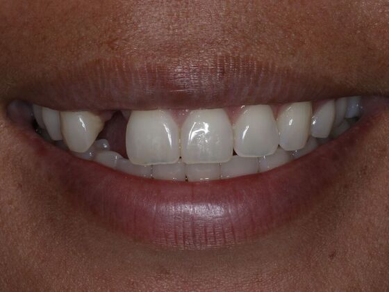 Dental Implants Case 8 - Before