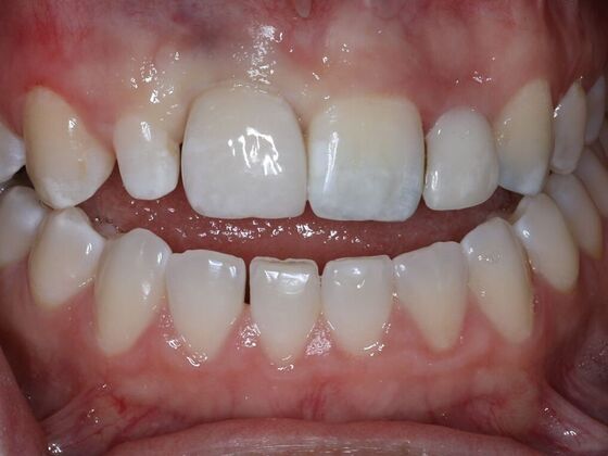 Dental Implants Case 9 - After