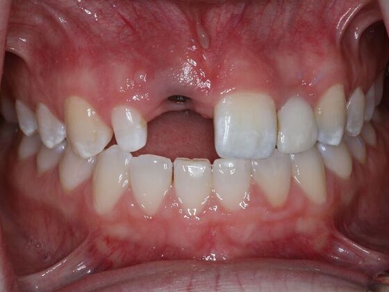 Dental Implants Case 9 - Before