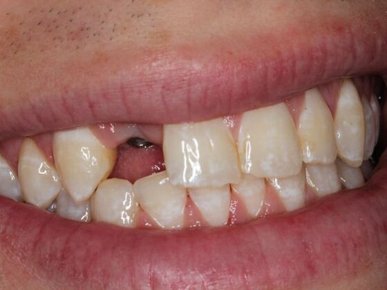 Dental Implants Case 10 - Before