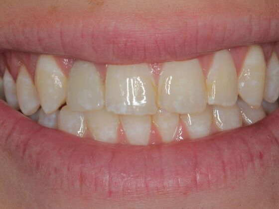 Dental Implants Case 10 - After