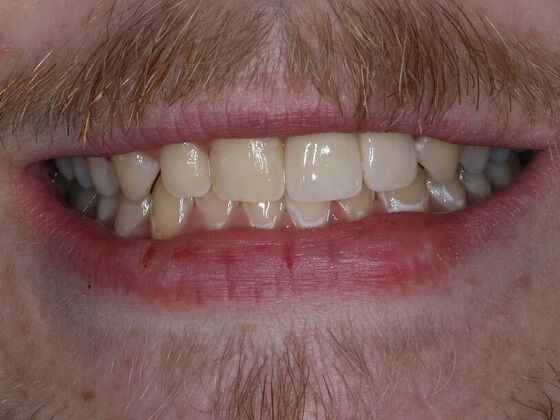 Dental Implants Case 11 - After