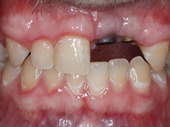 Dental Implants Case 11 - Before