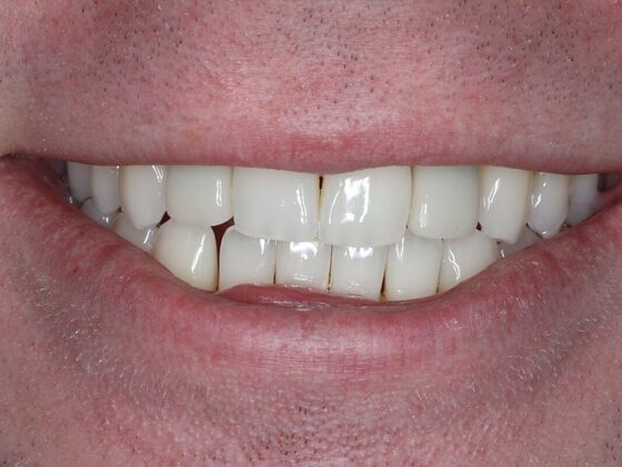 Dental Implants Case 12 - Before