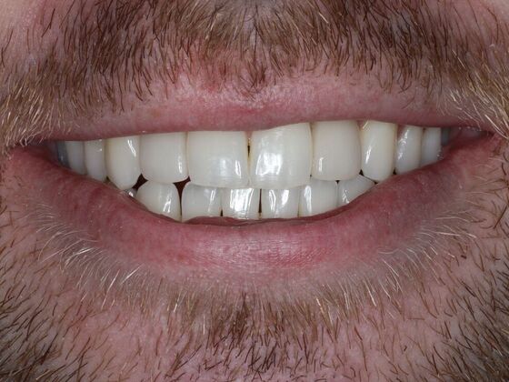 Dental Implants Case 12 - After