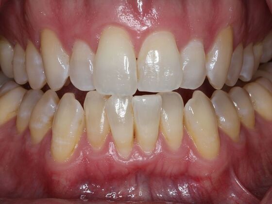 Invisalign Case 12 - Before