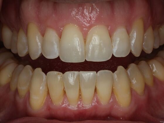 Invisalign Case 12 - After