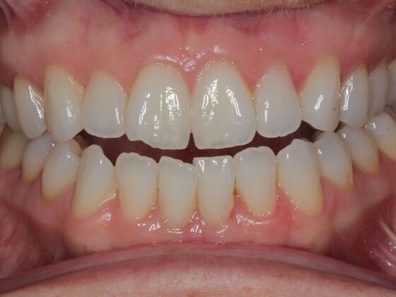 Invisalign Case 13 - Before