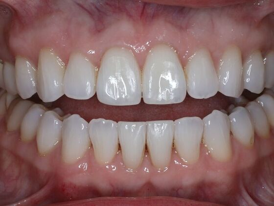 Invisalign Case 13 - After