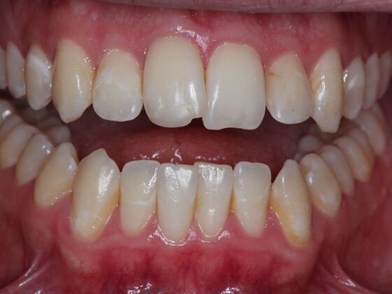 Invisalign Case 14 - Before
