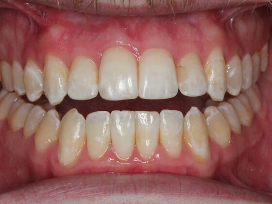 Invisalign Case 14 - After