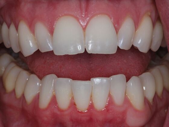 Invisalign Case 15 - Before