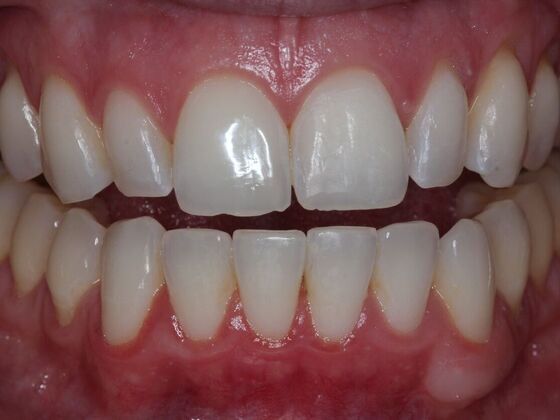 Invisalign Case 15 - After