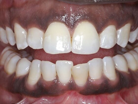 Invisalign Case 16 - Before