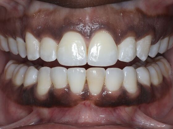Invisalign Case 16 - After