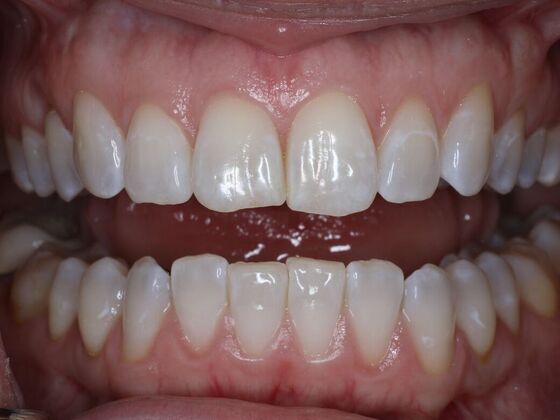 Invisalign Case 17 - Before