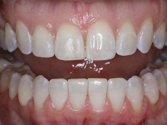 Invisalign Case 17 - After