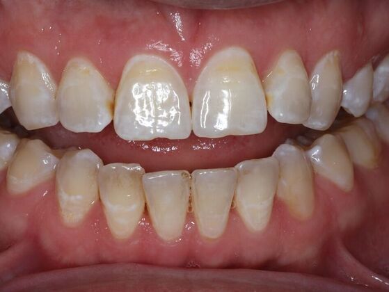 Invisalign Case 18 - Before