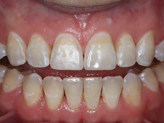 Invisalign Case 18 - After