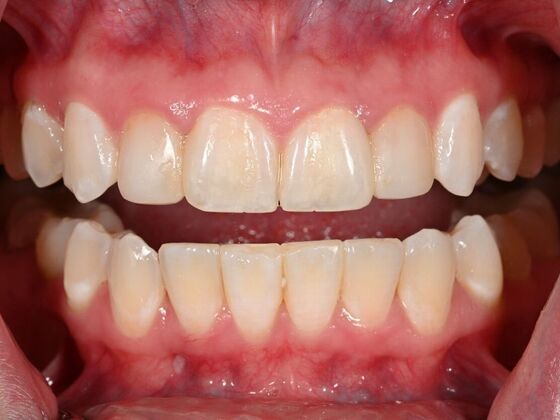 Invisalign Case 19 - After