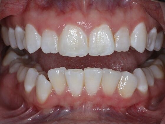 Invisalign Case 19 - Before