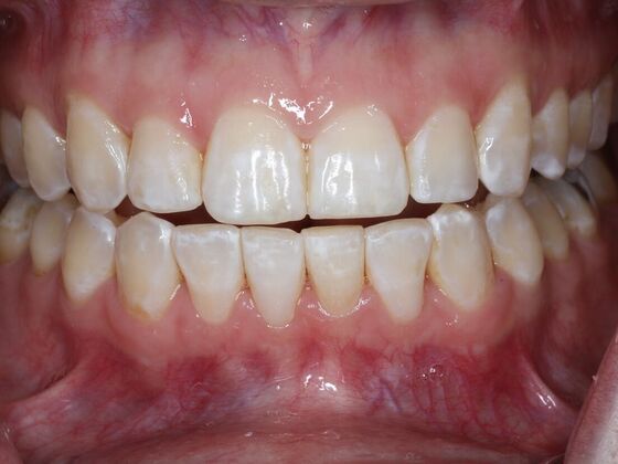 Invisalign Case 20 - After